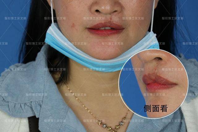 上唇偏薄且无唇珠的患者做了唇裂二期修复手术