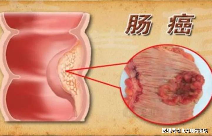 肠息肉是癌症的种子如何有效预防息肉发生