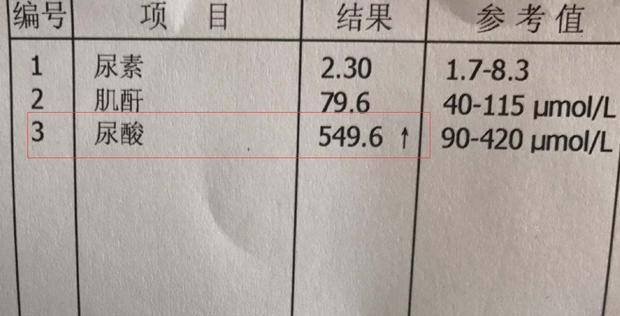 尿酸高的人注意！出现以下4个症状，下一步就是肾衰竭！