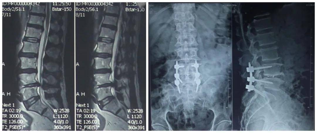 怎么样自己检测腰椎间盘突出 333a5fd1351248d1a342f4ff05a50c9e.jpeg