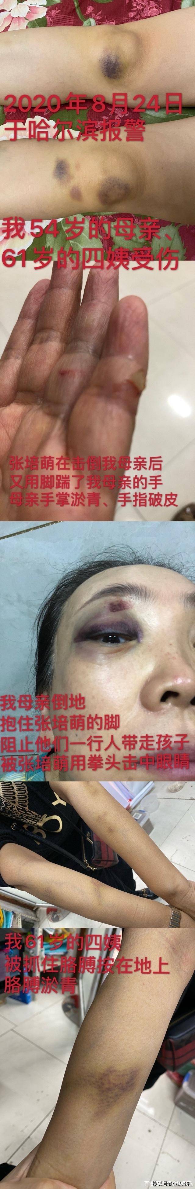 美女主播自爆运动员丈夫孕期家暴,被拔指甲还抢孩子,男方却甩锅给激素