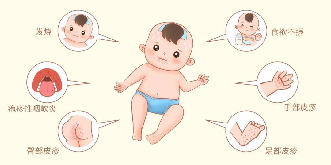 手足口病冬季也"发飙"!哪些预防必须做?