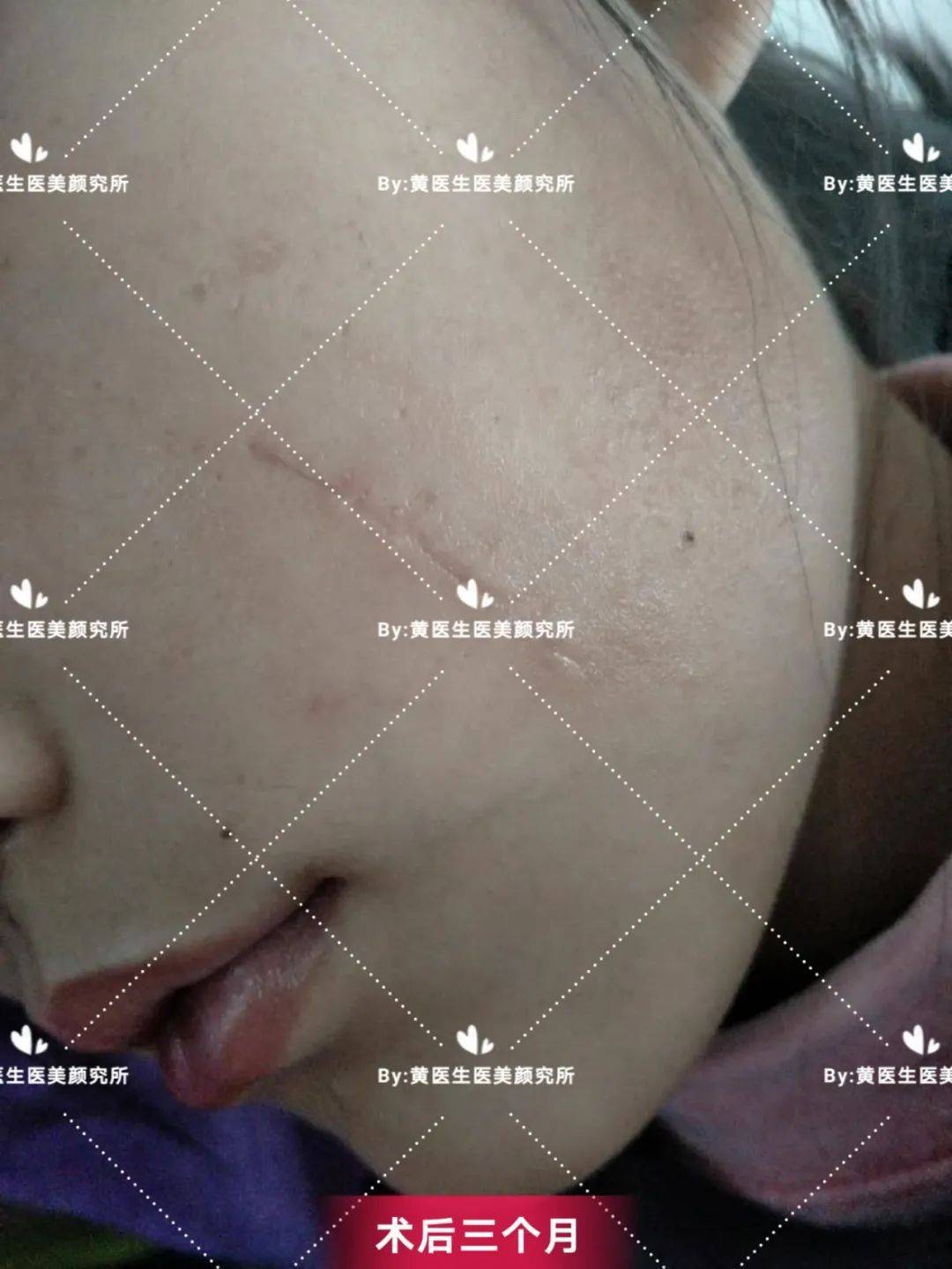 面部疤痕修复案例（二）_美容