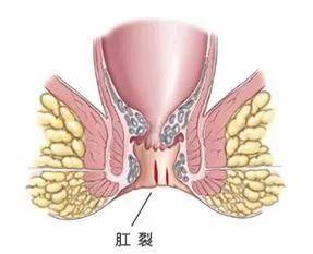 冬季肛肠病高发,是"攒着"还是"治疗"?_肛门