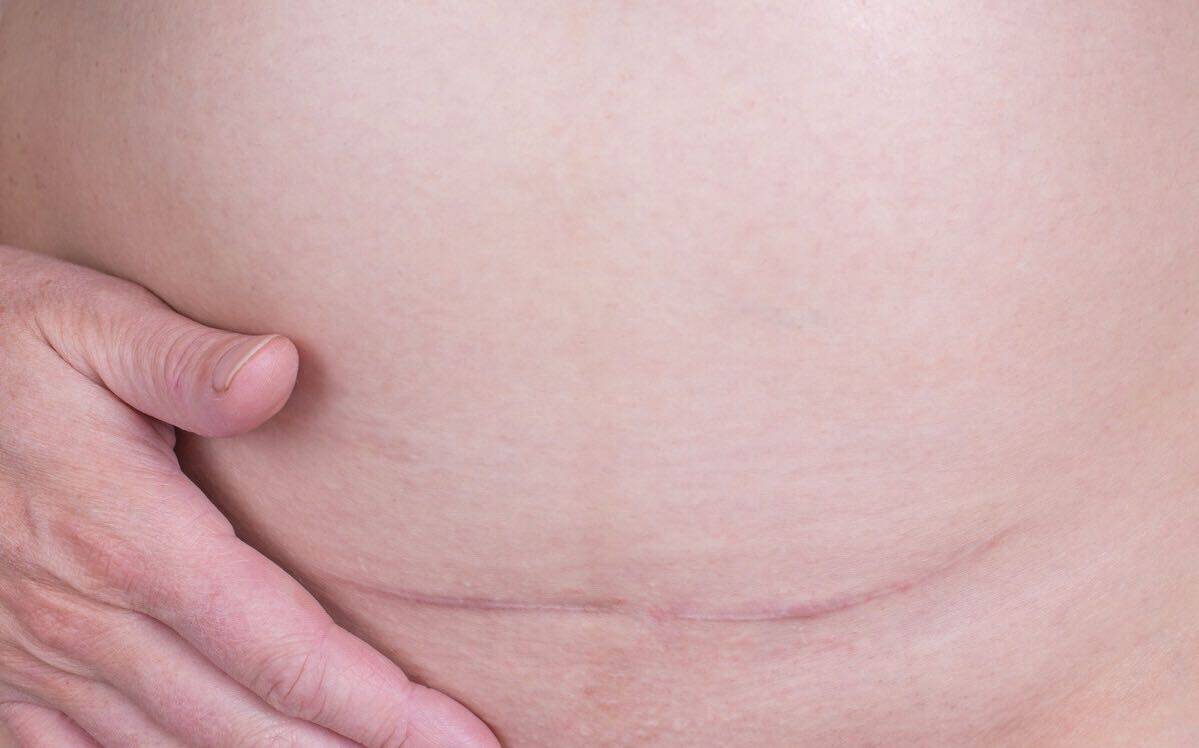侧切和剖宫产都要“挨刀”，哪个更疼？哪个更影响以后夫妻感情？
