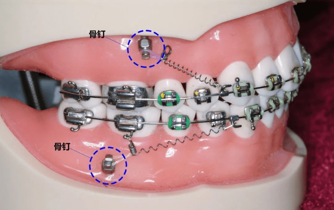 戴牙套为什么要打骨钉痛不痛