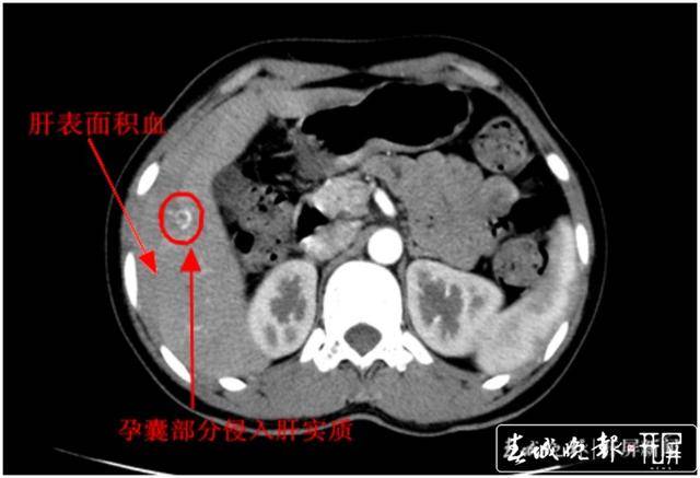 怀孕绞病是什么原理_绞龙砂是什么砂子