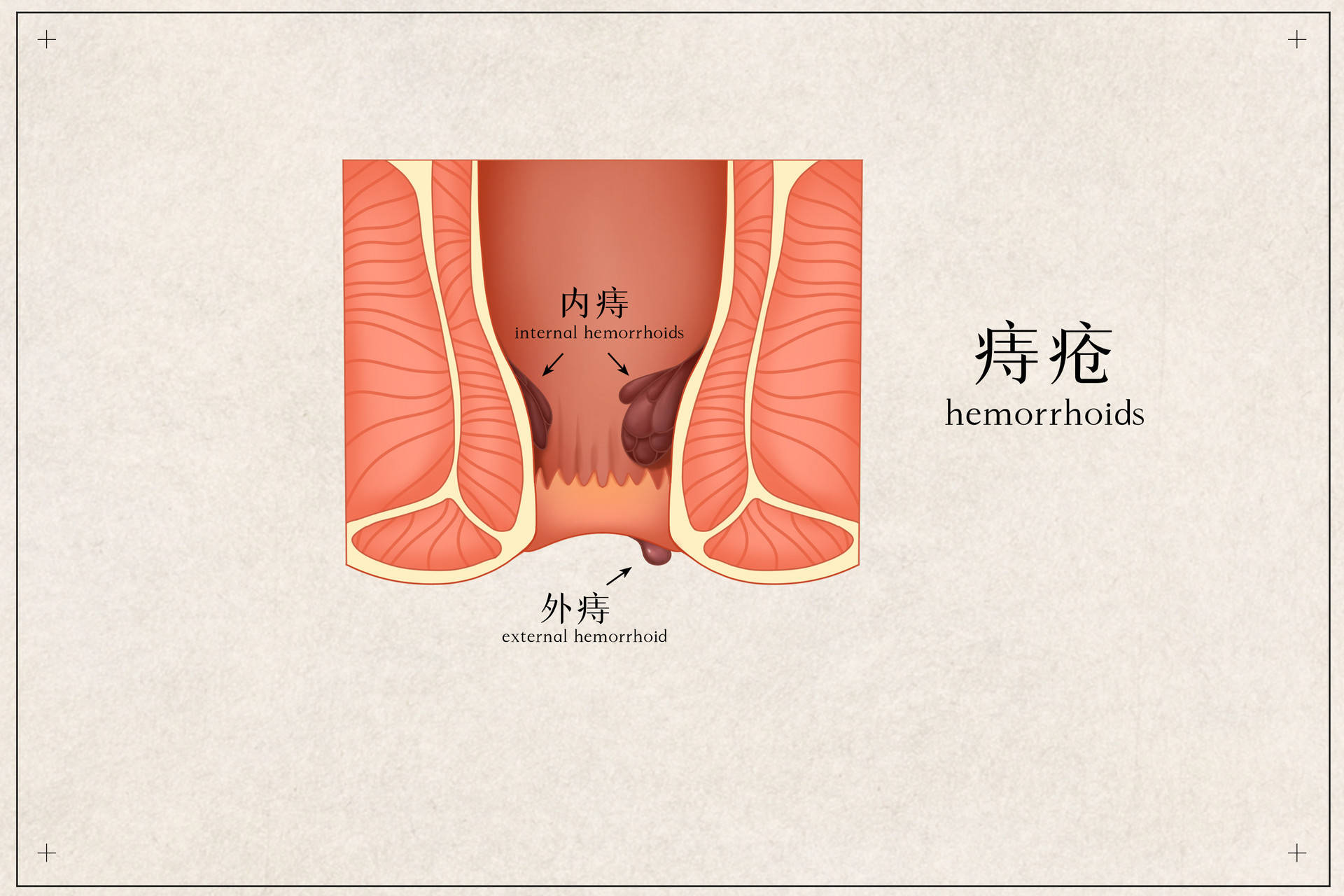 什么是痔疮?