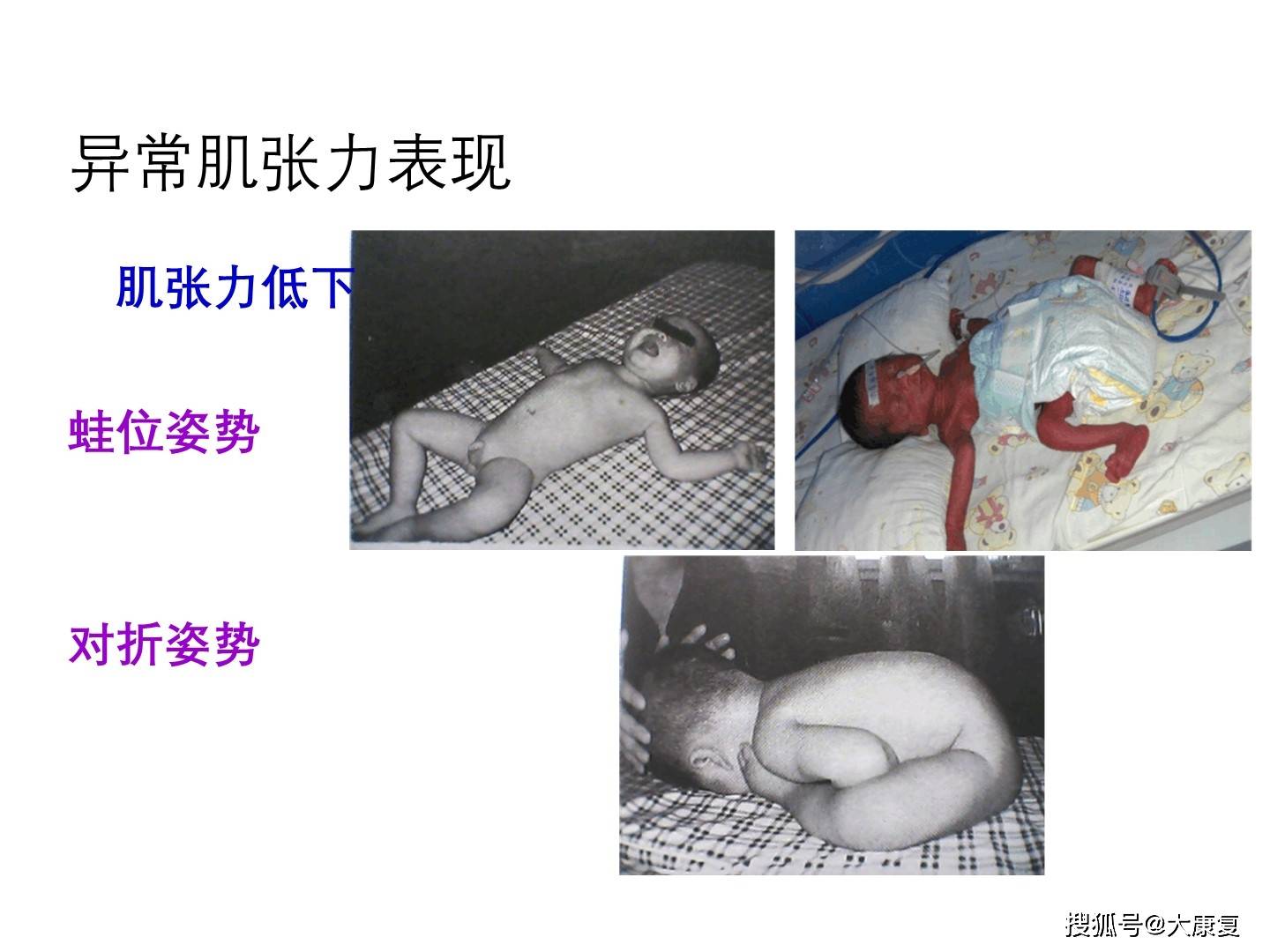原始反射及肌张力判定