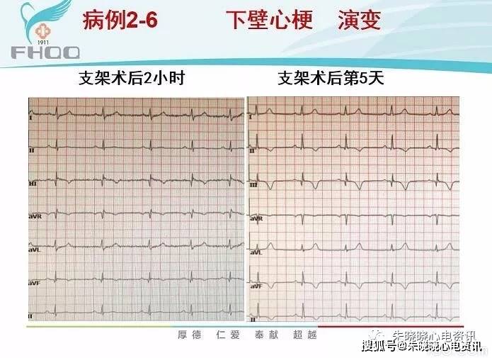 心肌缺血的心电图表现