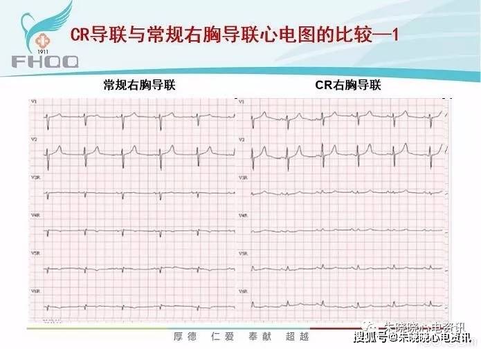 心肌缺血的心电图表现