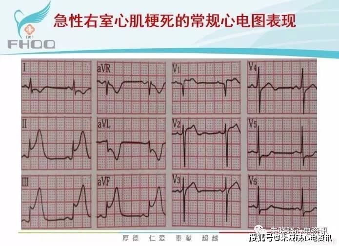 心肌缺血的心电图表现