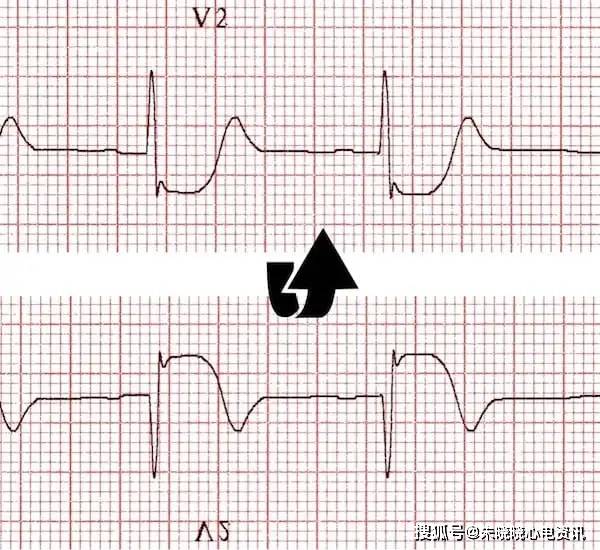 心肌缺血的心电图表现