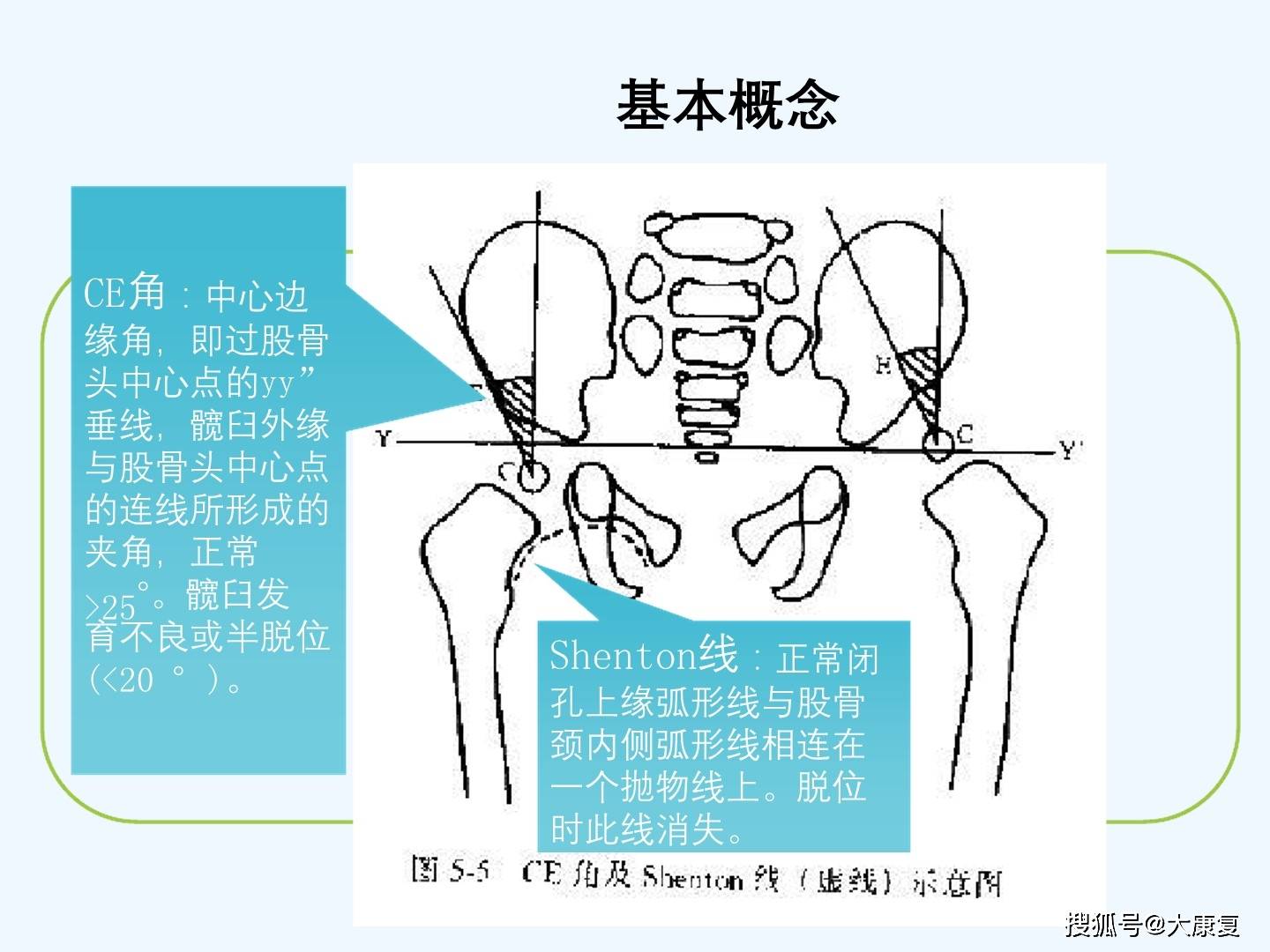 发育性髋关节脱位