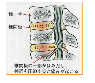 日本腰椎间盘突出治疗方法手术治疗手术治疗适用于长期保守治疗没有