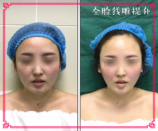 线雕适合多大年龄做做完大v线后感觉线断了找到原因