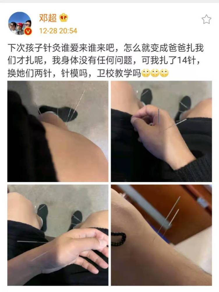 邓超为了让孩子针灸,做示范结果自己被扎了14针