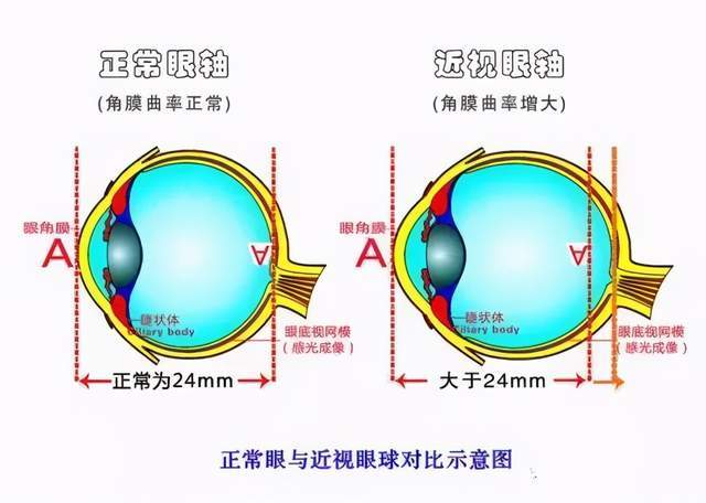 眼轴(建议每3个月测量一次)