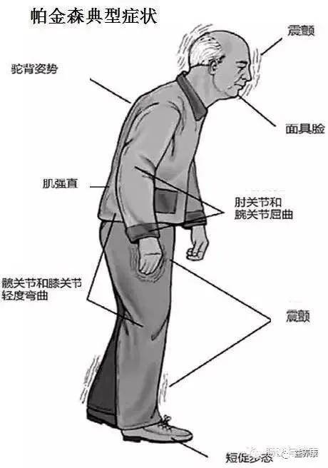 什么情况下要装脑起搏器 9b956f5e7569465b81b143a185c6254f.jpeg