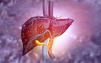 美国大约25%的人患有脂肪肝,这种疾病会导致肝脏纤维化,最终导致肝