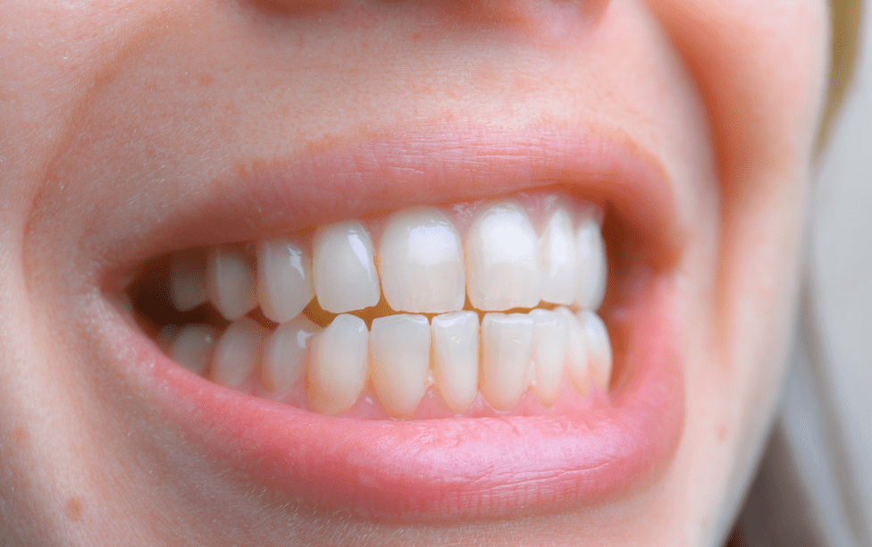 其实健康的牙齿颜色应该是淡黄半透明的象牙色.