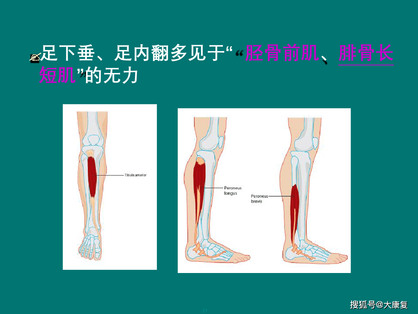 常见中枢性足下垂足内翻的处理策略