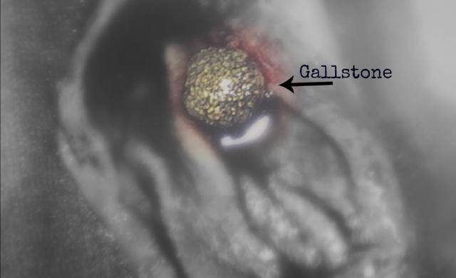 怎么样才能不长结石 4c4d0aef2cab4fbcbe6b8b38ae351e75.jpeg