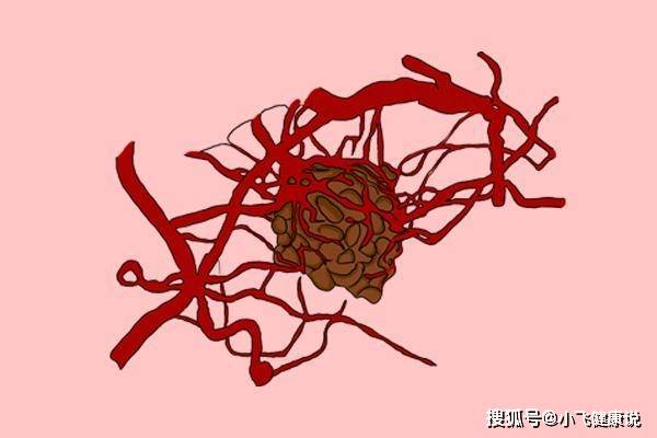 怎么才能不长肠息肉 780c6374590a4c2984a0c0ca2acff00c.jpeg