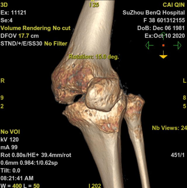 【图为患者膝关节进行ct平扫后的三维重建影像】