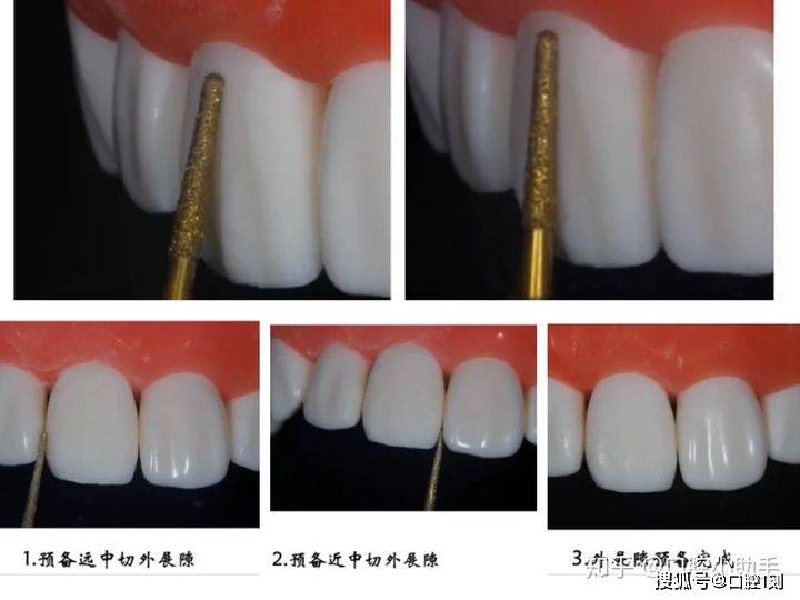 美学修复牙体预备要领(四)之贴面的分类预备