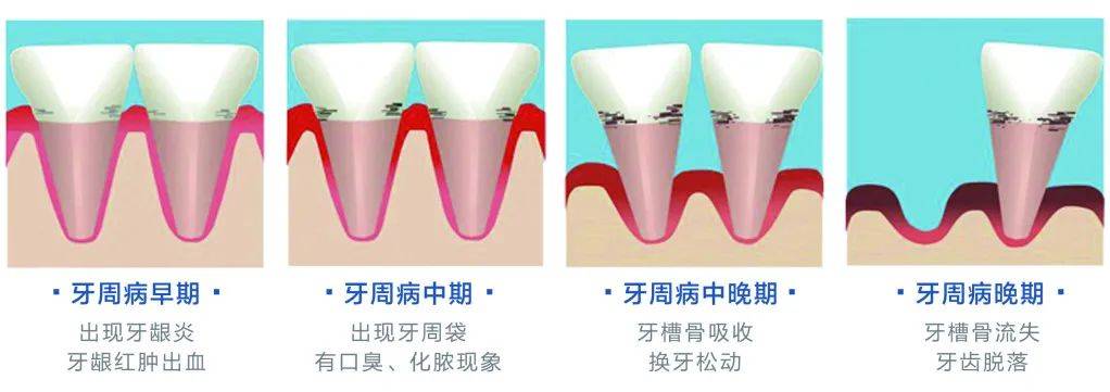 牙周病的早期症状不易引起重视,造成牙周组织长期慢性感染,炎症反复