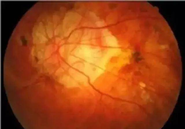 视网膜遗传性眼病中发病率最高的是_眼电图和视网膜电图_手机砸眼视网膜脱离
