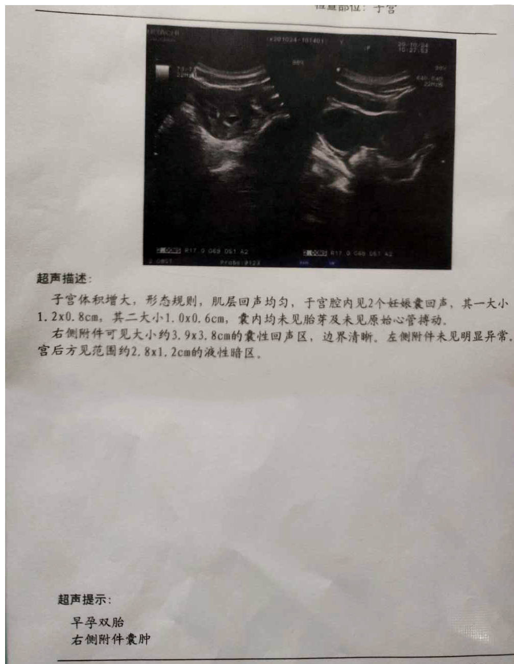 惊喜不断多囊终于怀孕竟然还是双胎