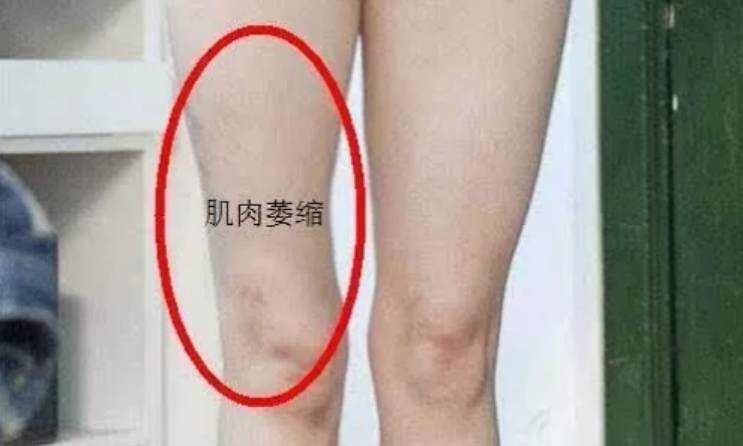 为什么术后肌肉萎缩很难恢复