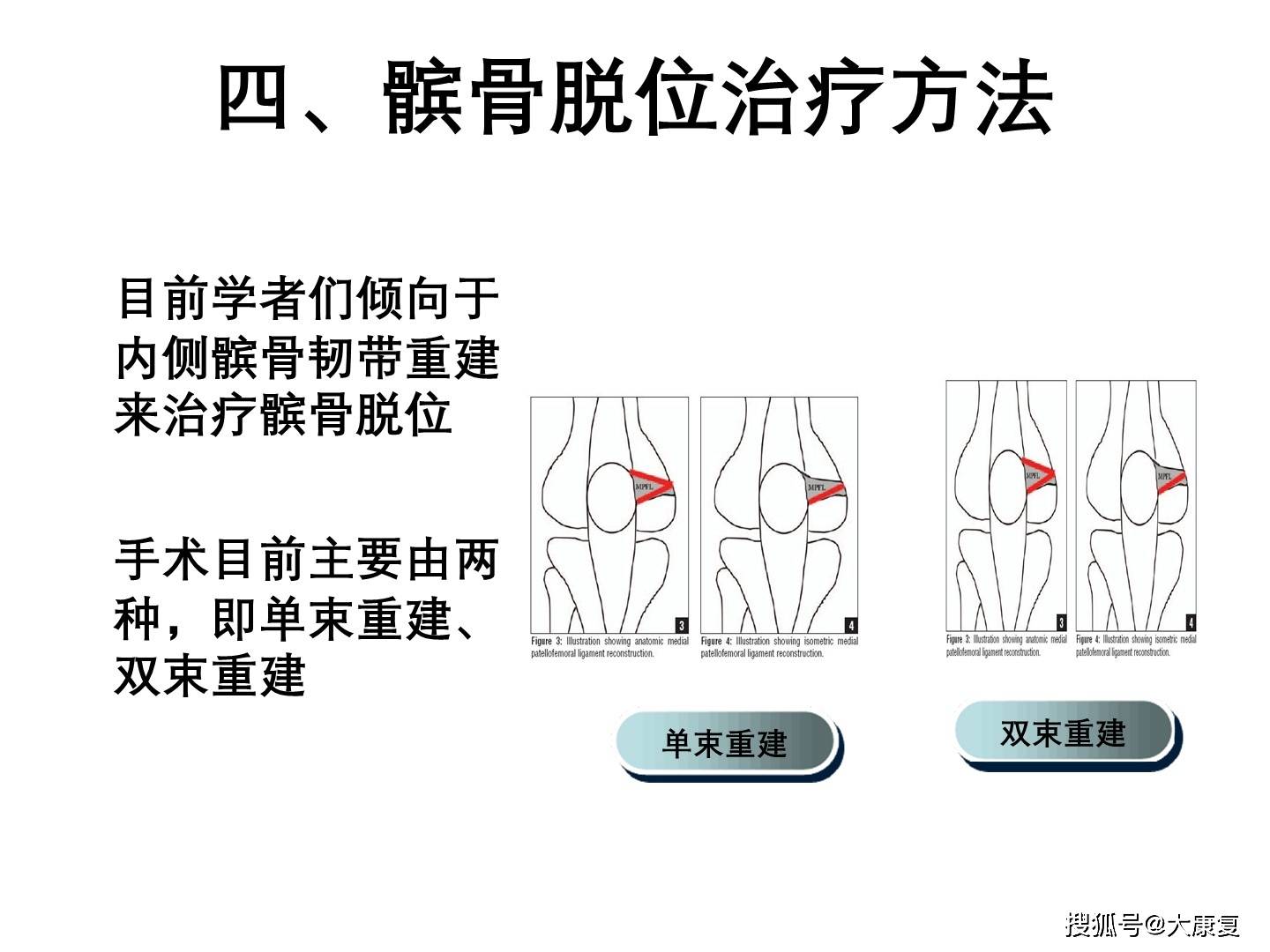 髌骨脱位ppt