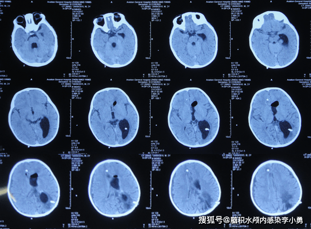 2岁脑肿瘤术后3月内间断发热呕吐,腰大池和脑室外引流