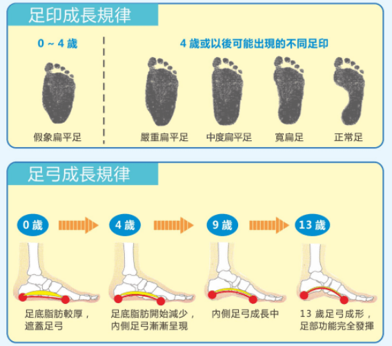 儿童足底脂肪逐渐较少,足弓便逐渐显现出来,完成从扁平足到正常足的