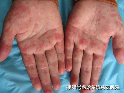 急性红斑狼疮是我们并不常见的一种皮肤疾病,属于红斑狼疮的一种