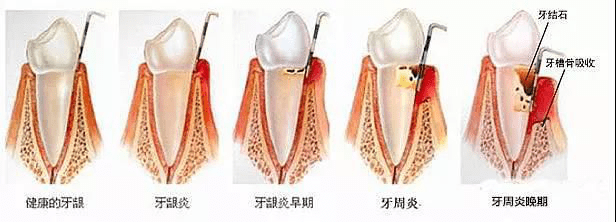 大连齿医生口腔 牙龈炎=牙周炎?两者不仅仅是一字之差