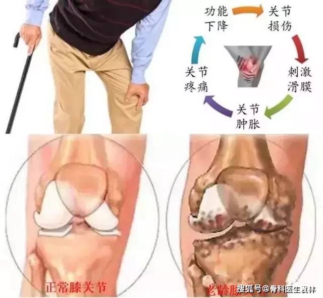膝关节滑膜炎的症状有哪些