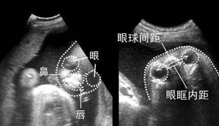 孕妇做四维彩超,胎儿鼻子扁又大,胎儿也是有苦说不出啊!