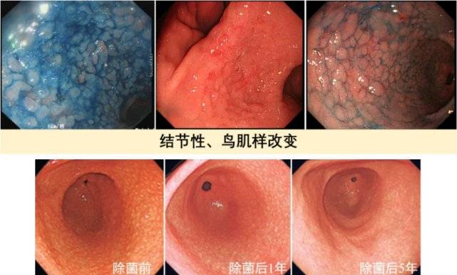 南京鼓楼医院邹晓平教授内镜所见hp感染到胃癌的漫漫历程上