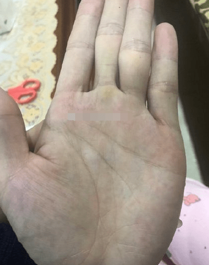 原创金星丘有痣,富裕之象,只要持之以恒,好日子等着你.