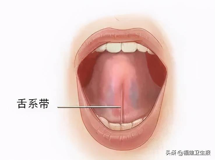 所谓的舌系带,是舌头和口底间的一个条状组织.