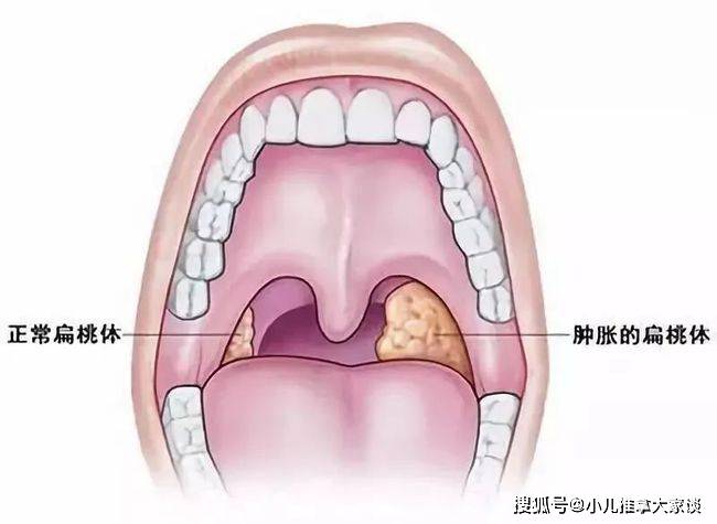 2,腺样体肥大