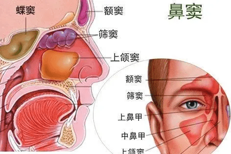 鼻炎:鼻炎是鼻腔内部的炎症,虽然也会伴有菌类感染,但其主要病因在