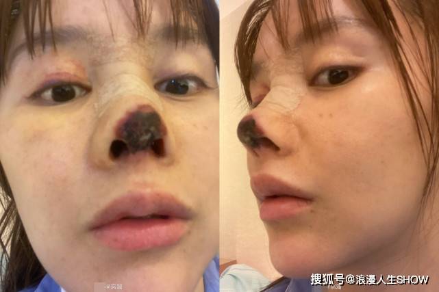 原创女星高溜隆鼻失败毁容,鼻子发黑坏死维权未果,给爱美女孩记警钟