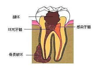 事实上,牙齿的解剖结构使得龋坏往往呈现口小底大的三角形.