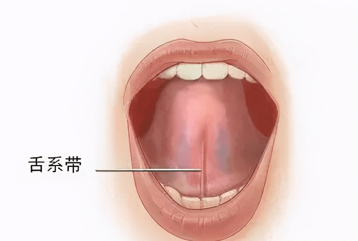 时常背锅的舌系带 所谓的舌系带,是舌头和口底间的一个条状组织.