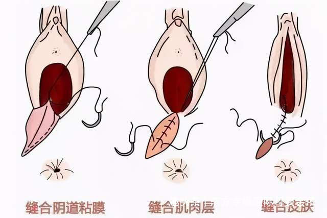 顺产时侧切或撕裂能否对产妇生活造成影响先了解一下